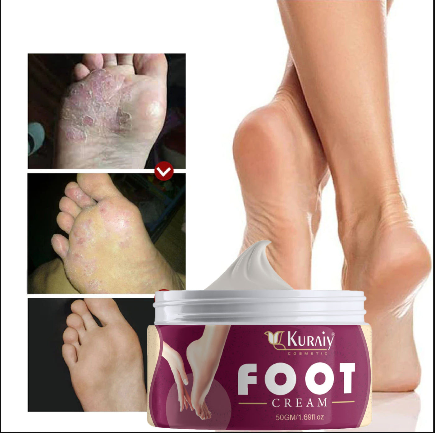 KURAIY Foot Crack Tea Tree Balm For Dry Cracked Heels & Feet Foot Cream & Hand Cream (50gm) ( For women and men) Pack of 1 Foot Creams & Lotions